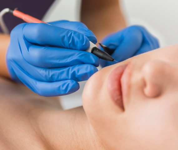 electrolysis hair removal treatment city laser lab